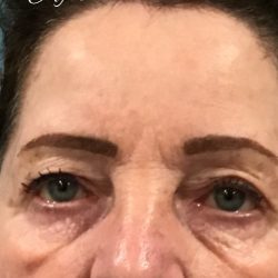 BroadBand Light Therapy (BBL) Before & After Patient #2316