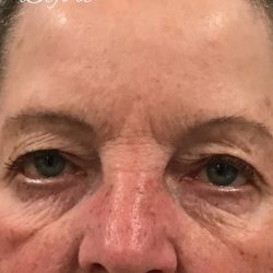 BroadBand Light Therapy (BBL) Before & After Patient #2316