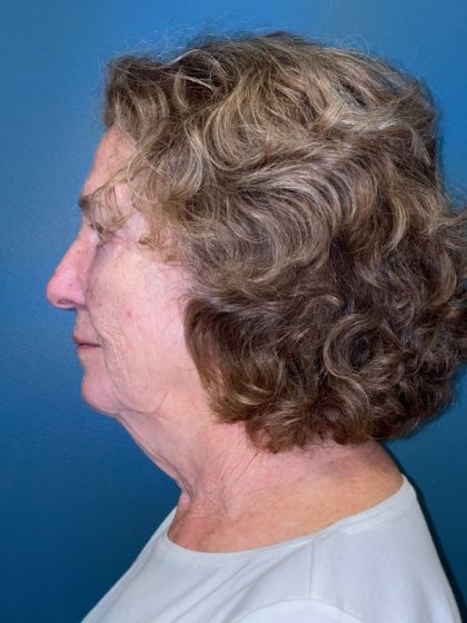 Neck Lift Before & After Patient #2329