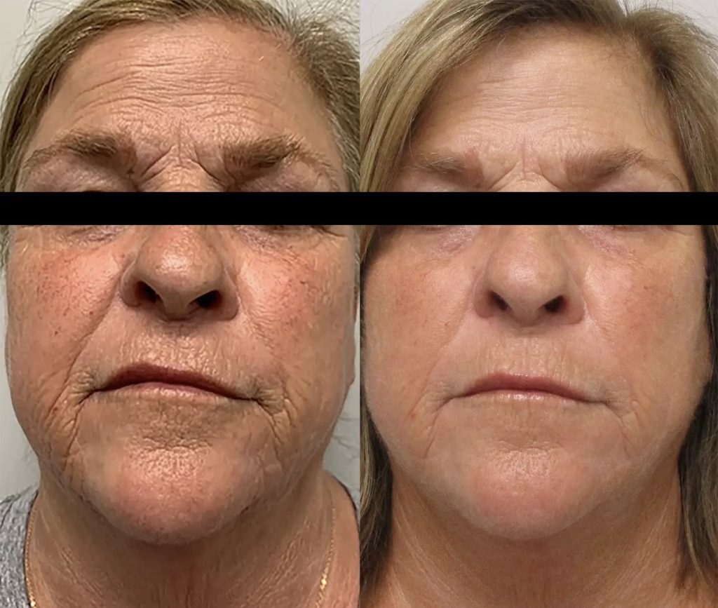 rf wrinkle reduction lexington