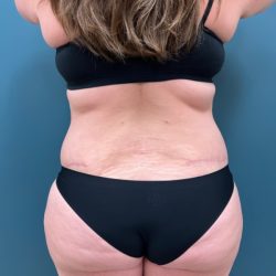 Liposuction Before & After Patient #2343