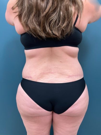 Liposuction Before & After Patient #2343