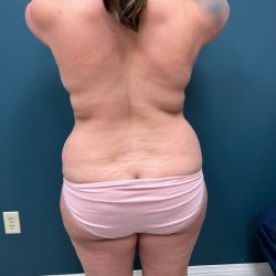Liposuction Before & After Patient #2343