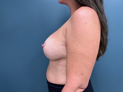 Breast Augmentation Before & After Patient #2355