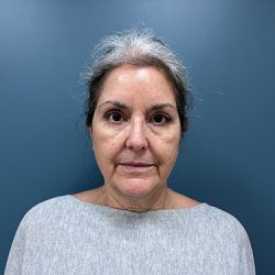 Facelift Before & After Patient #2393