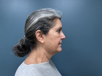 Facelift Before & After Patient #2393