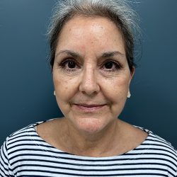 Facelift Before & After Patient #2393