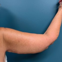 Arm Lift Before & After Patient #2346