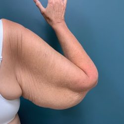 Arm Lift Before & After Patient #2346