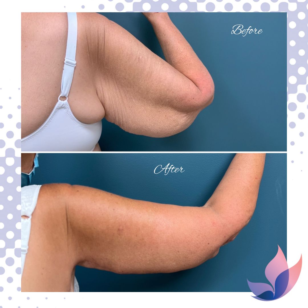 Best Arm Lift Lexington, KY  Plastic Surgeons of Lexington