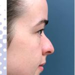 Rhinoplasty Before & After Patient #2352