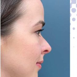 Rhinoplasty Before & After Patient #2352