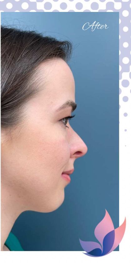 Rhinoplasty Before & After Patient #2352