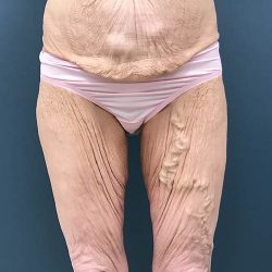Lower Body Lift Before & After Patient #2430