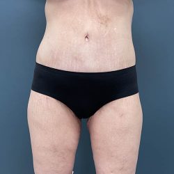Lower Body Lift Before & After Patient #2430