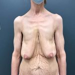 Breast Lift Before & After Patient #2433