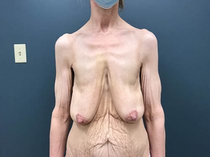 Breast Lift Before & After Patient #2433