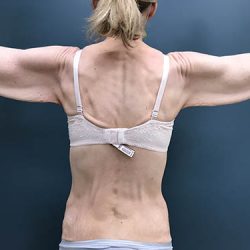 Arm Lift Before & After Patient #2425