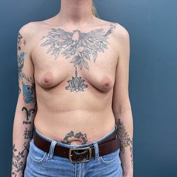 Breast Augmentation Before & After Patient #2534