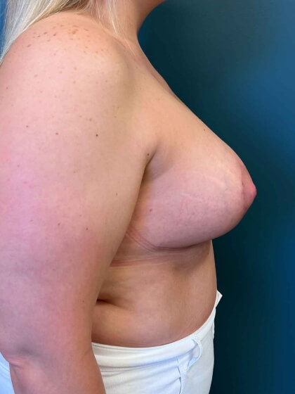 Breast Augmentation Before & After Patient #1688