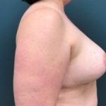 Breast Reconstruction Before & After Patient #388