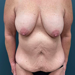 Lower Body Lift Before & After Patient #2503