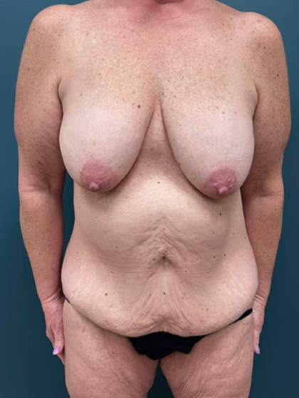 Lower Body Lift Before & After Patient #2503