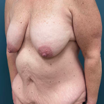 Lower Body Lift Before & After Patient #2503
