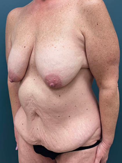 Lower Body Lift Before & After Patient #2503
