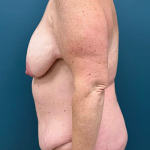 Lower Body Lift Before & After Patient #2503