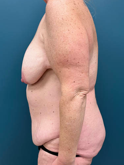 Lower Body Lift Before & After Patient #2503