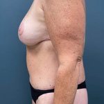 Lower Body Lift Before & After Patient #2503