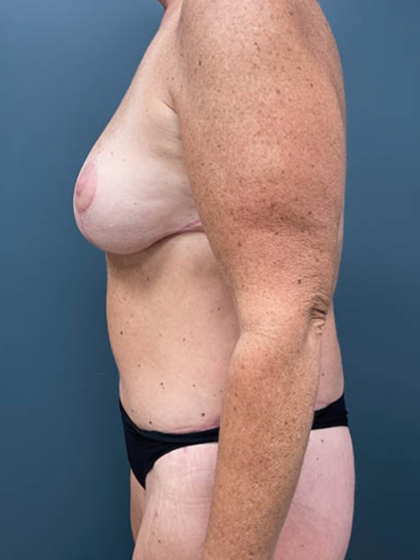 Lower Body Lift Before & After Patient #2503