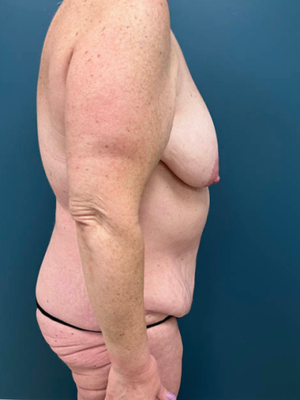 Lower Body Lift Before & After Patient #2503