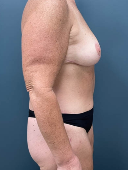Lower Body Lift Before & After Patient #2503
