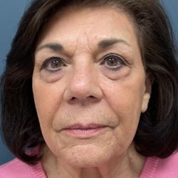Blepharoplasty Before & After Patient #2556
