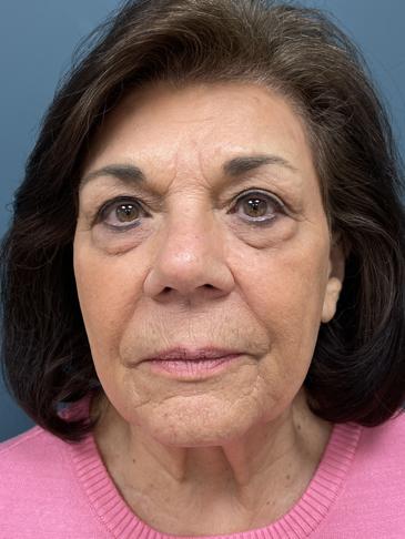 Blepharoplasty Before & After Patient #2556