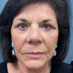 Blepharoplasty Before & After Patient #2556