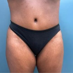 Tummy Tuck Before & After Patient #2567