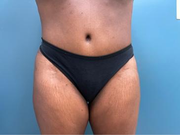 Tummy Tuck Before & After Patient #2567