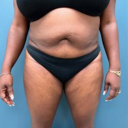 Tummy Tuck Before & After Patient #2567