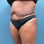 Tummy Tuck Before & After Patient #2567