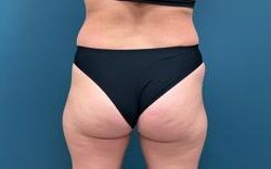 Brazilian Butt Lift Before & After Patient #2616