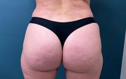 Brazilian Butt Lift Before & After Patient #2616