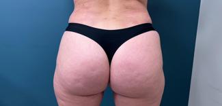 Brazilian Butt Lift Before & After Patient #2616