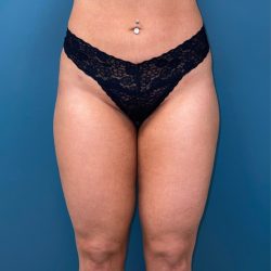 Liposuction Before & After Patient #2839
