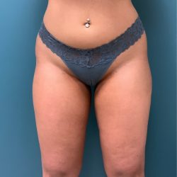 Liposuction Before & After Patient #2839