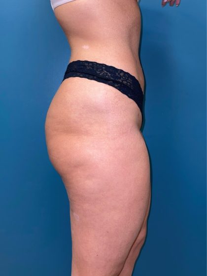 Liposuction Before & After Patient #2839