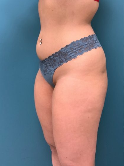 Liposuction Before & After Patient #2839