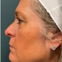 Morpheus8 Before & After Patient #2808